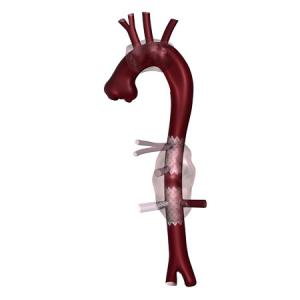 Embolic Medical Device Technology
